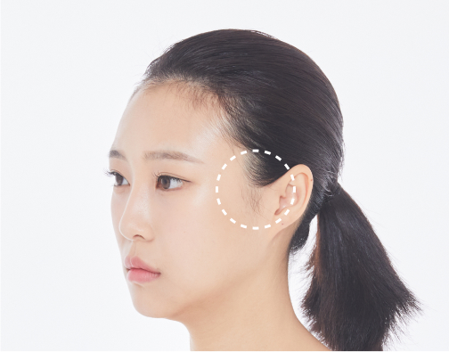 비절개 모발이식 before