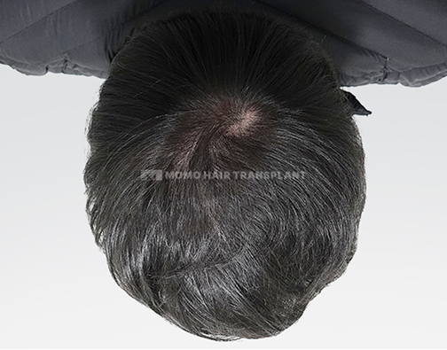 여성 정수리 모발이식 after