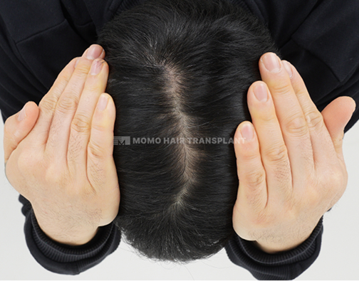 여성 이마거상 흉터커버 비절개 after