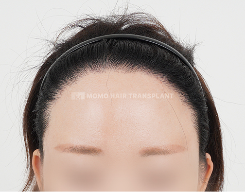 여성 절개 모발이식 after
