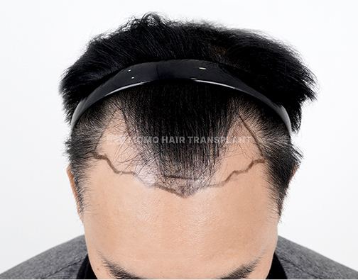 남성 절개 모발이식 before