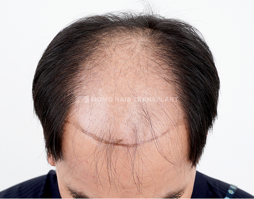 남성 절개 모발이식 before