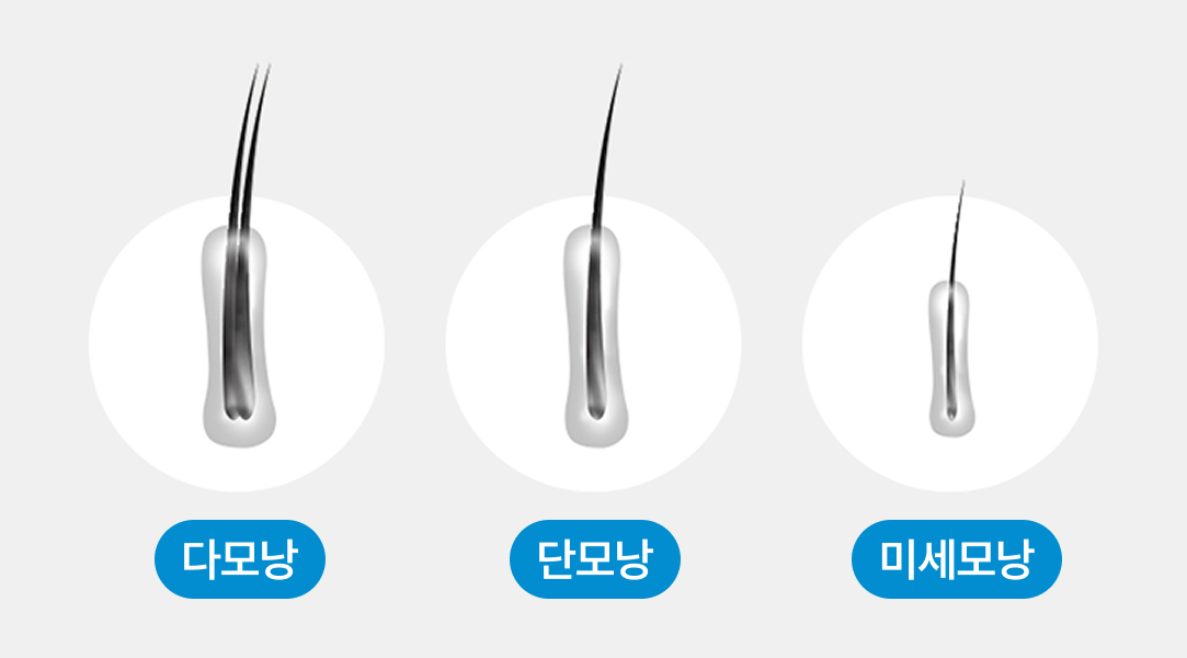 이마 그라데이션 이식