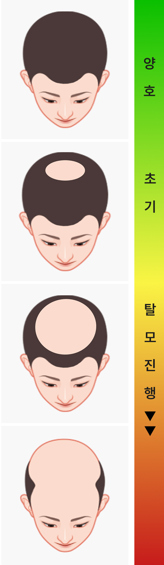 O자형 탈모 단계