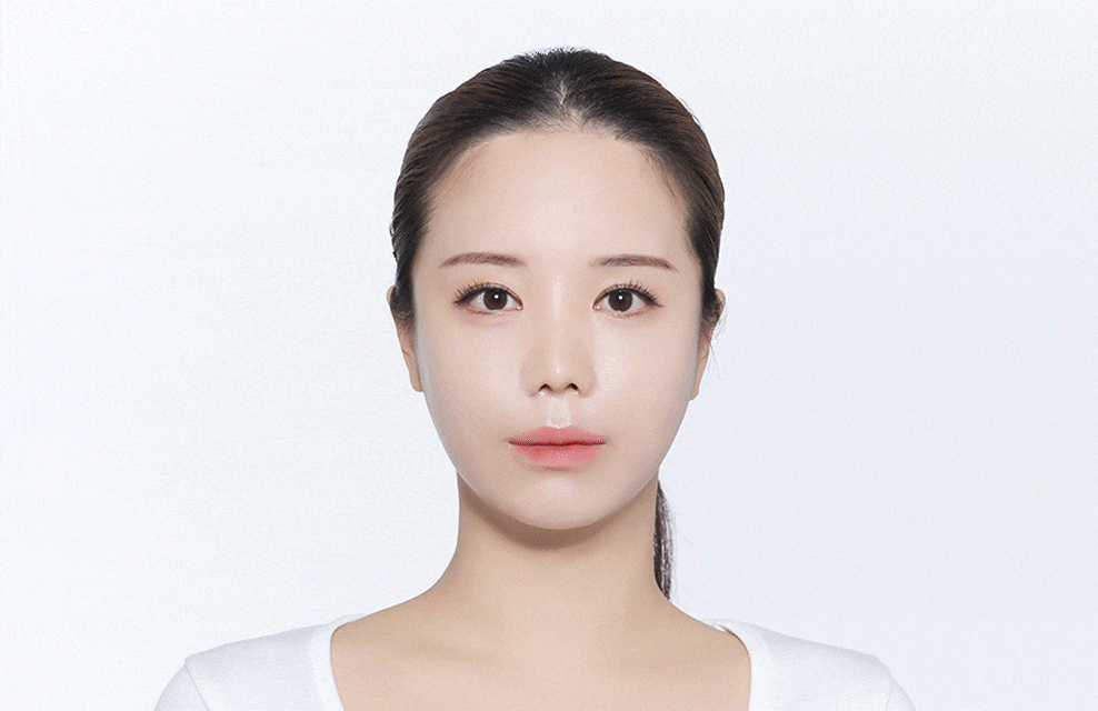 수술로 인한 헤어라인 변형