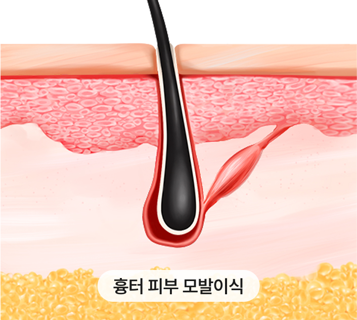 수술로 인한 헤어라인 변형