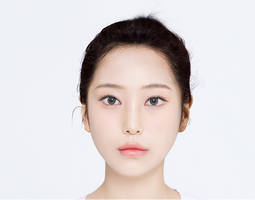 비절개 모발이식 after