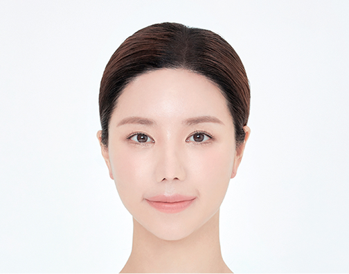 비절개 모발이식 after