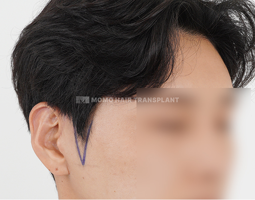 구레나룻 모발이식 before