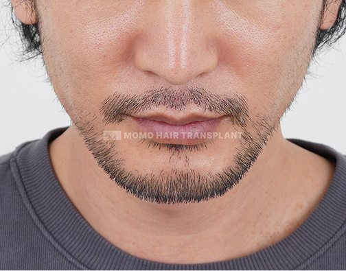 수염 모발이식 before